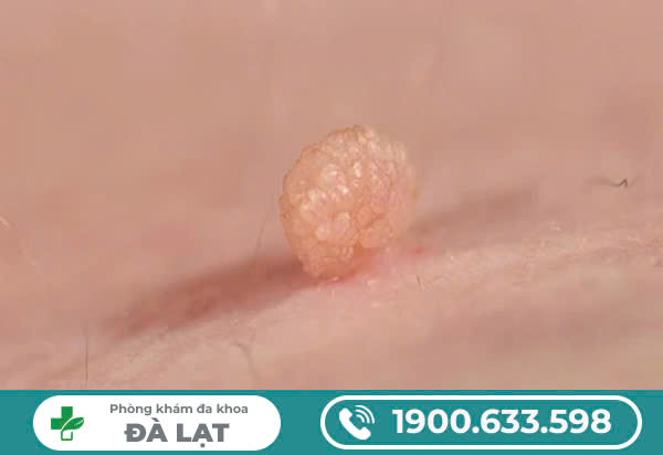 CÁCH CHỮA MỤN THỊT Ở VÙNG KÍN? PHƯƠNG PHÁP ĐIỀU TRỊ HIỆU QUẢ NHẤT?